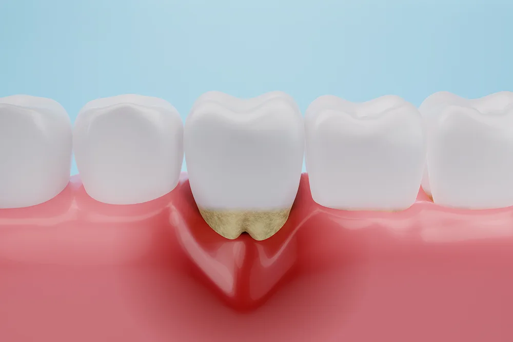 Parodontitis behandeln bei Zahnmedizin Achental